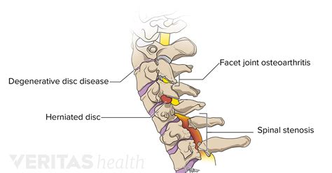 How Cervical Degenerative Disc Disease Causes Pain And Other Symptoms