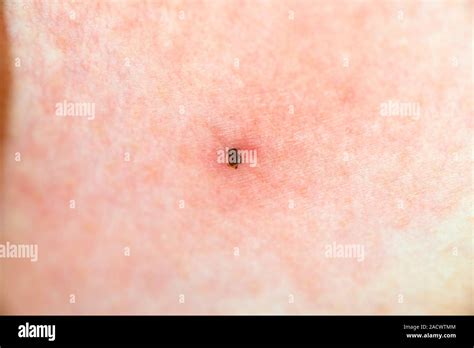 Mouthparts Of A Tick Buried In The Skin Of A 39 Year Old Womans Thigh