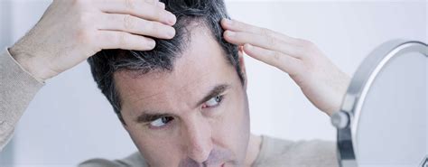 Hair Transplant 10 Things To Consider Before You Decide