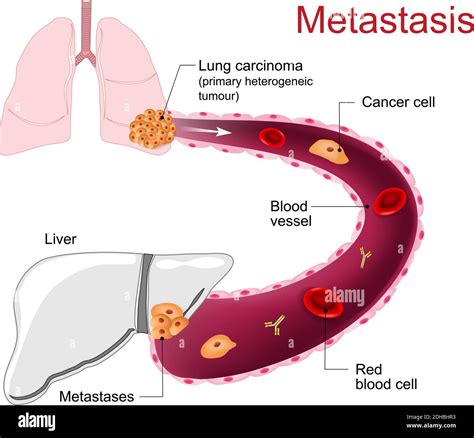 Metastasis Liver Stock Vector Images Alamy