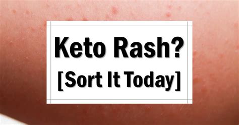 Keto Rash Explained Plus How To Treat A Keto Rash The Keto Eater