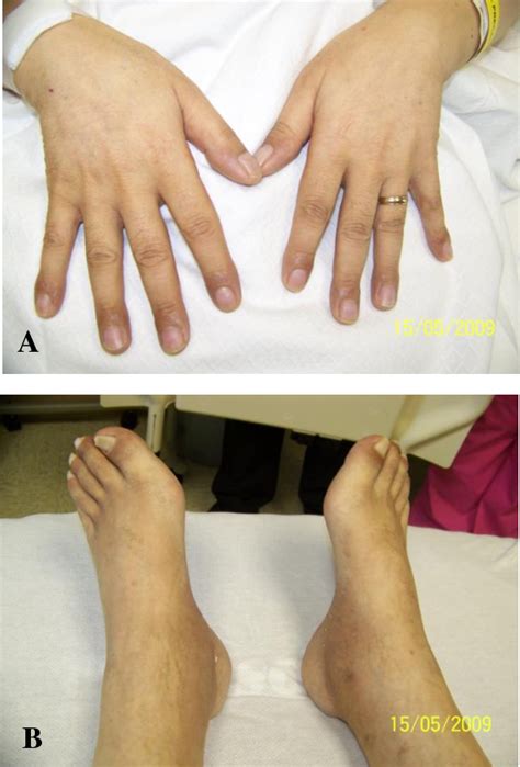 Figure 1 From Hypertrophic Pulmonary Osteoarthropathy As The Presenting