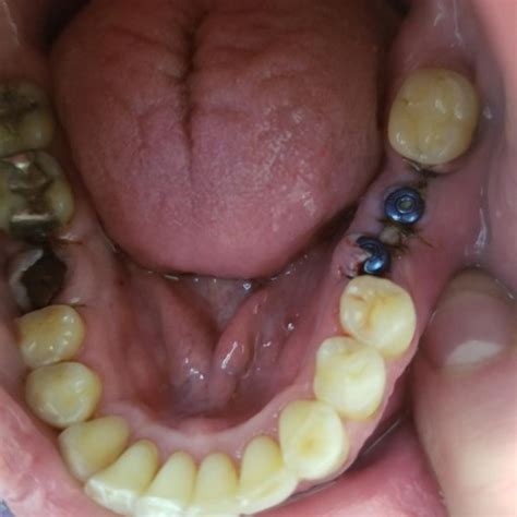 You have to wear your braces between 20 and 22 hours a day since each patient is different, it is important to fix an appointment with one of our invisalign providers as the. Sore gums four months after bone graft