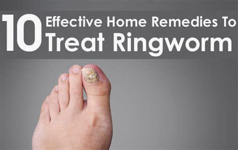 10 Effective Home Remedies To Treat Ringworm ~ Mzizi Mkavu