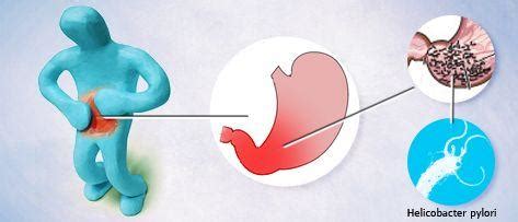 人乳头瘤病毒 (hpv) 是美国最常见的性传播感染。 性活跃人士即使只与一人发生性行为，也可能感染 hpv。 症状可能在与感染人士发生性行为多年后出现，以至于难以追究最初在何时感染。 你的幽門螺桿菌體檢結果，竟可能是錯的？ - 每日頭條