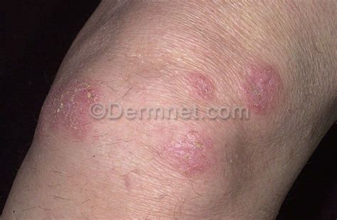 Differential Diagnosis Nummular Eczema Seborrheic Dermatitis Eczema
