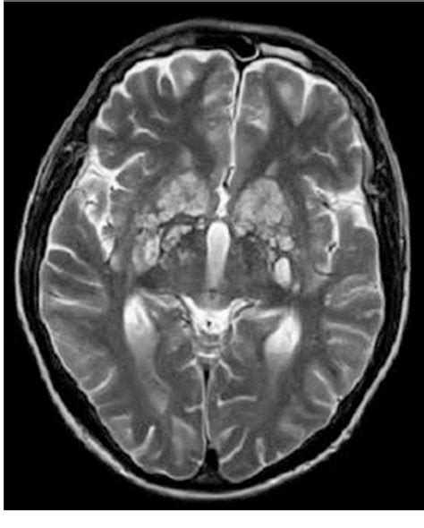 Pdf Cryptococcalcsf Ventricular Levels On Mri Brain In A Man With
