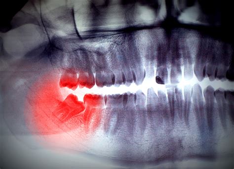 3 Signs You Need To Get Your Wisdom Teeth Removed City Dentists