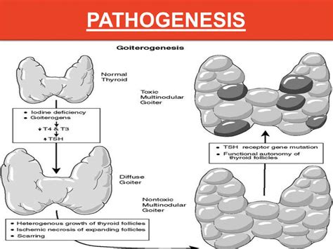 Hypothyroidism Diffuse Toxic Goiter Graves Disease Basedow Disease