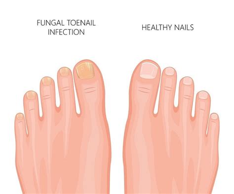 Yellow Toenails What They Say About Your Health And How To Treat Them