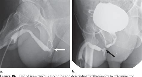 Figure 4 from Urethral injuries after pelvic trauma ...