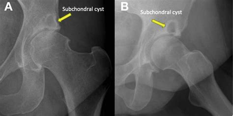 Hip Cysts Acetabular Paralabral Cyst And Subchondral Cyst Fai