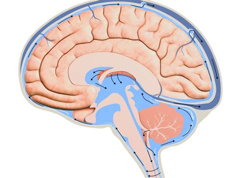 Ventriculoperitoneal Vp Shunt Surgery