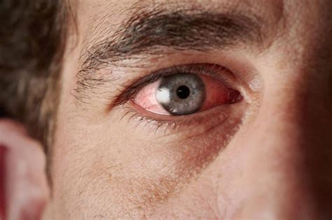 Sjogrens Syndrome Causes And Symptoms