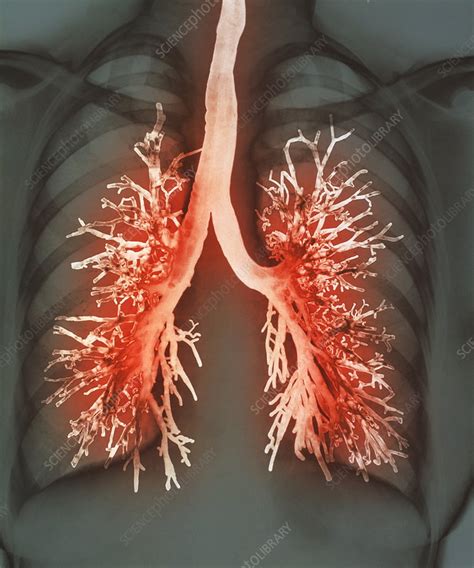Lung Airways Stock Image P5800126 Science Photo Library