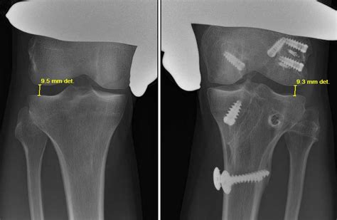 Posterolateral Reconstruction Complex Knee Surgeon Minnesota
