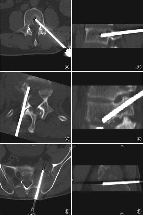Value Of Ct‐guided Core Needle Biopsy In Diagnosing Spinal Lesions A