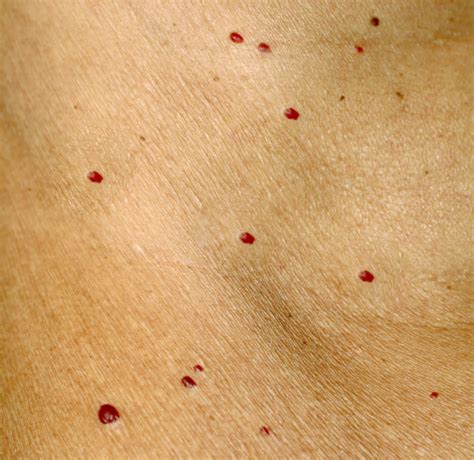Small Pinpoint Red Dots On Skin Clipsay