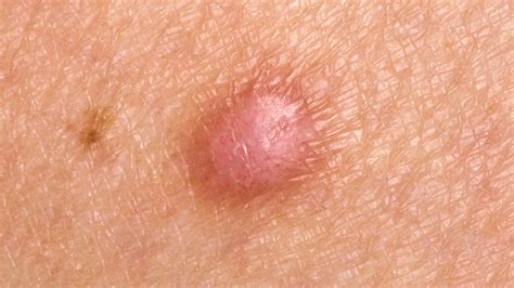 What Is A Skin Lump Symptoms Causes Diagnosis Treatment And