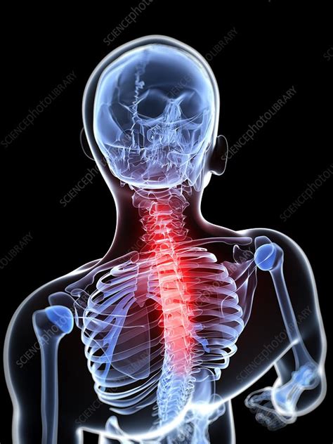 Back Pain Conceptual Artwork Stock Image F0068069 Science Photo