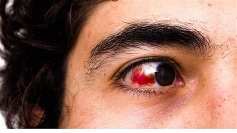 19 Reasons For Having Red Eyes Bloodshot Eyes Causes