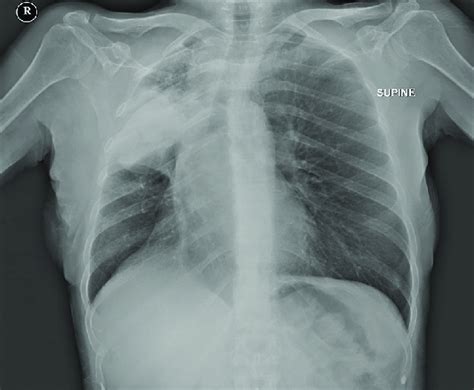 Anterior Posterior Chest X Ray Showing A Radiopaque Area In The Right