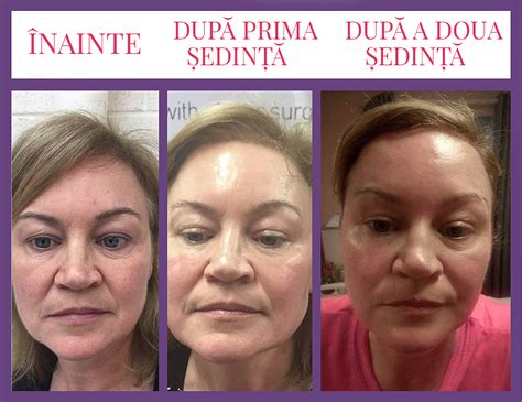 Botox Non Invaziv Skin Expert Constanța