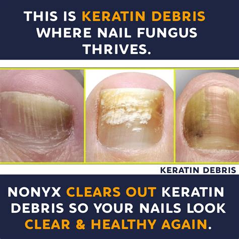 Nonyx Fungal Nail Clarifying Gel Clears Out Keratin Debris Where Nail