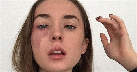 Woman With Facial Birthmark Is Going Viral For Her Inspirational Body