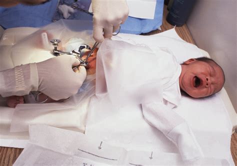 Circoncision Tout Ce Quil Faut Savoir Sur La Circoncision Du Bébé