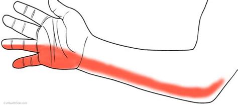 4·5번째 손가락 저리면 팔꿈치터널증후군 의심해야 Ctn25문화관광