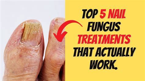 Top 5 Nail Fungus Treatments That Actually Work Youtube