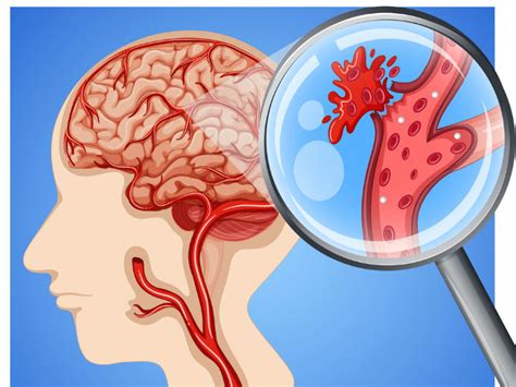 Imágenes para el diagnóstico del accidente cerebrovascular agudo. ¿Cómo evitar un accidente cerebrovascular? | Salud180