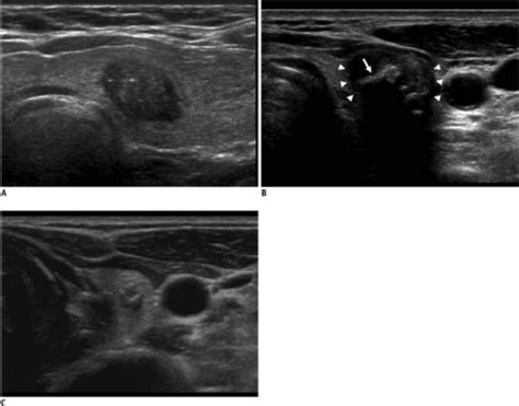 Calcifications Of Thyroid Nodules A Microcalcification Open I