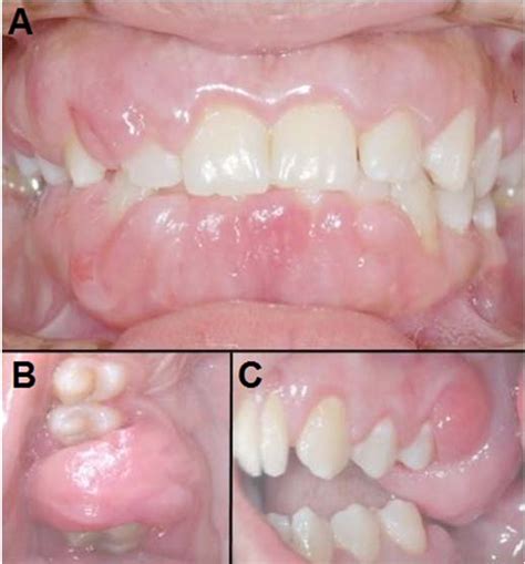 Intraoral Clinical Aspect Gingival Hyperplasia Is Widespread And