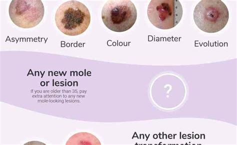 Common Signs Of Skin Cancer Otosection