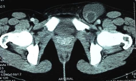 Ct Scan Of Abdomen And Pelvis With Intravenous Contrast Showing Obvious