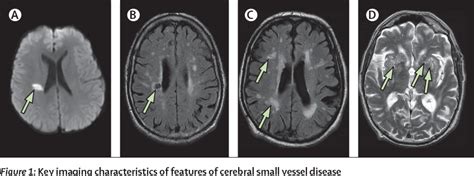 Neuroimaging Standards For Research Into Small Vessel 60 Off