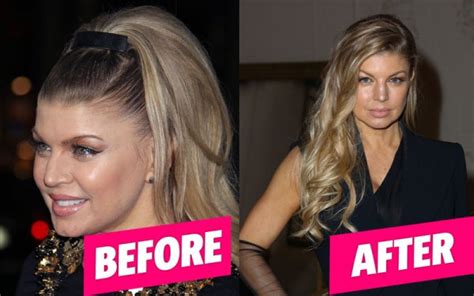 Fergies Facial Plastic Surgery — See The Pics Star Magazine