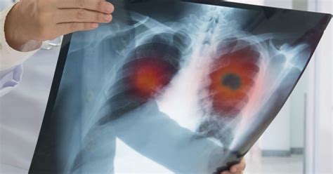 Why Is Lung Cancer So Difficult To Treat
