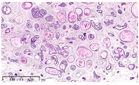 Papillary Eccrine Adenoma International Journal Of Dermatology And