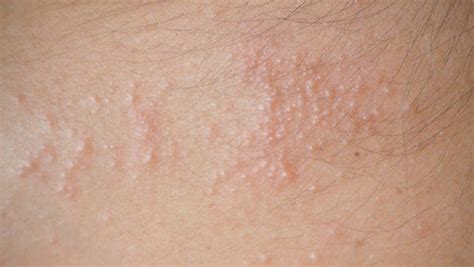How To Get Rid Of Heat Rash With The Right Treatment Insider