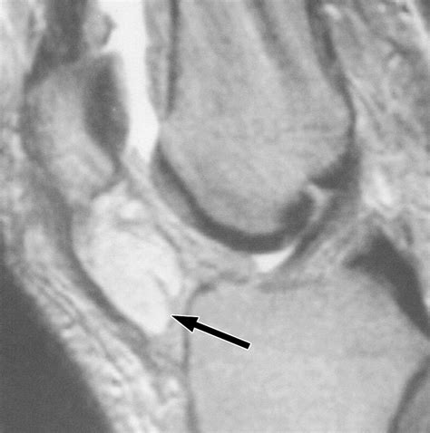 Neoplastic And Tumorlike Lesions Detected On Mr Imaging Of The Knee In