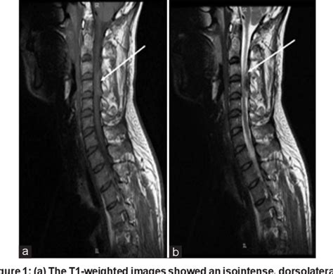 Figure 1 From Acute Spontaneous Cervical Spinal Epidural Haematoma A