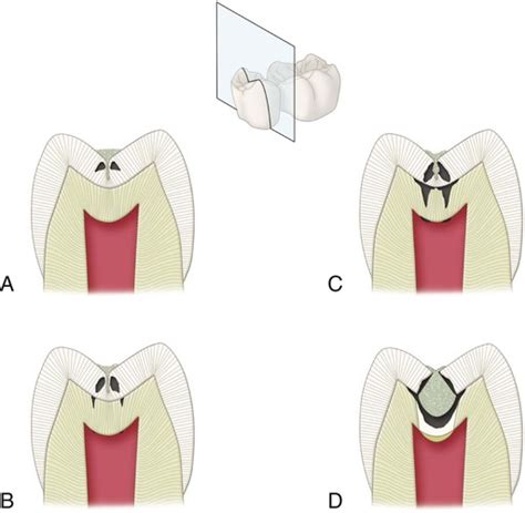 2 Dental Caries Etiology Clinical Characteristics Risk Assessment