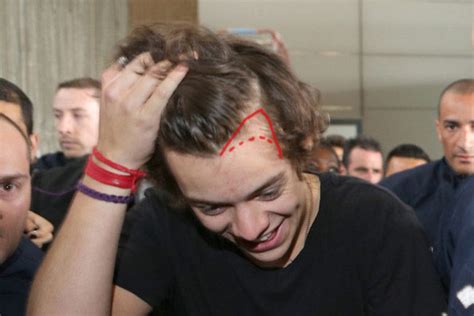 Harry Styles Hair Loss How Bad Is It