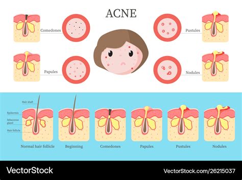 Acne Types And Formation Infographics Flat Vector Image