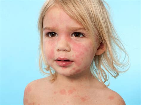 Hives In Toddlers Babycenter