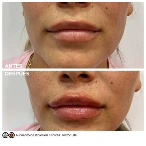 Relleno Y Aumento De Labios Con Ácido Hialurónico Dr Life