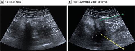 Still Another Case Of Right Lower Quadrant Abdominal Pain Emergency